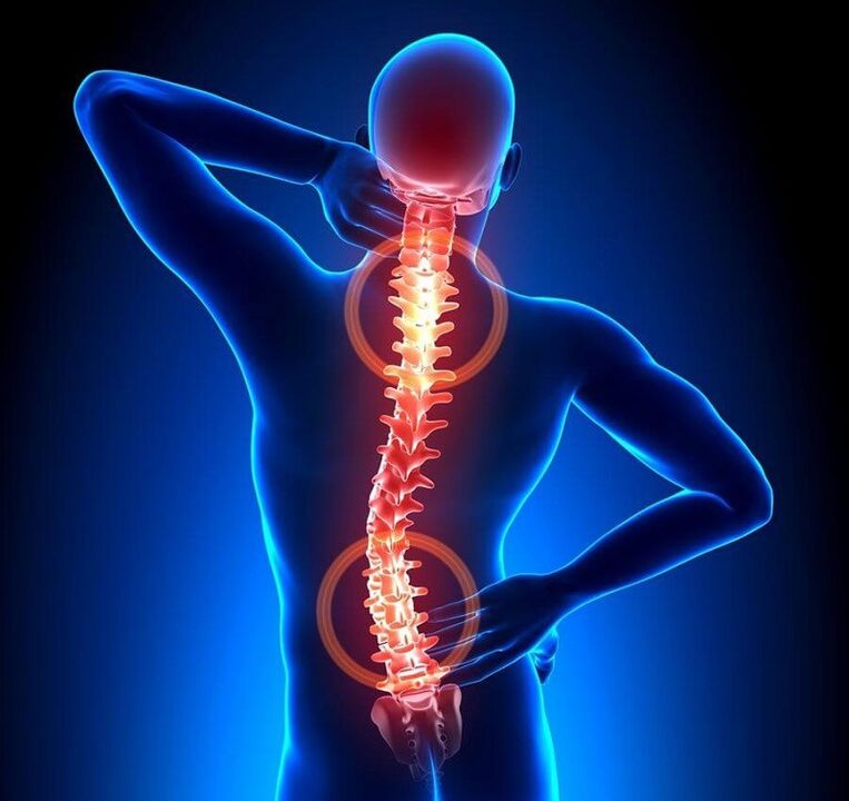 spinal osteochondrosis as a cause of back pain