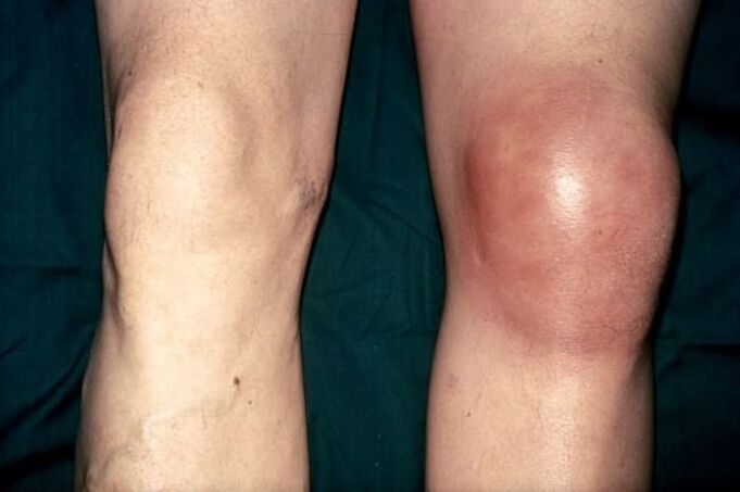 healthy and swollen knee with pain