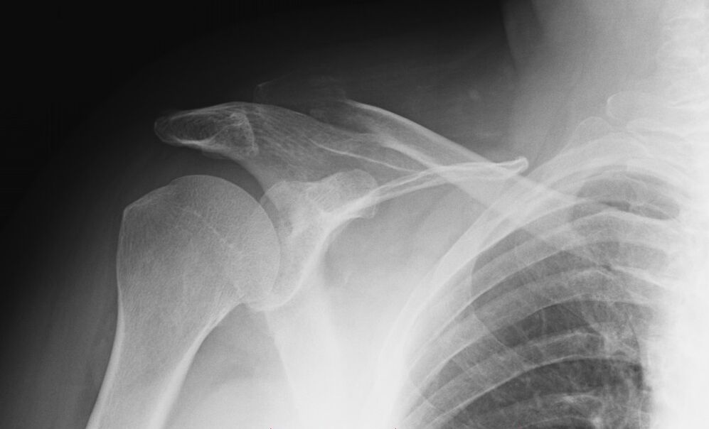 shoulder osteoarthritis radiography