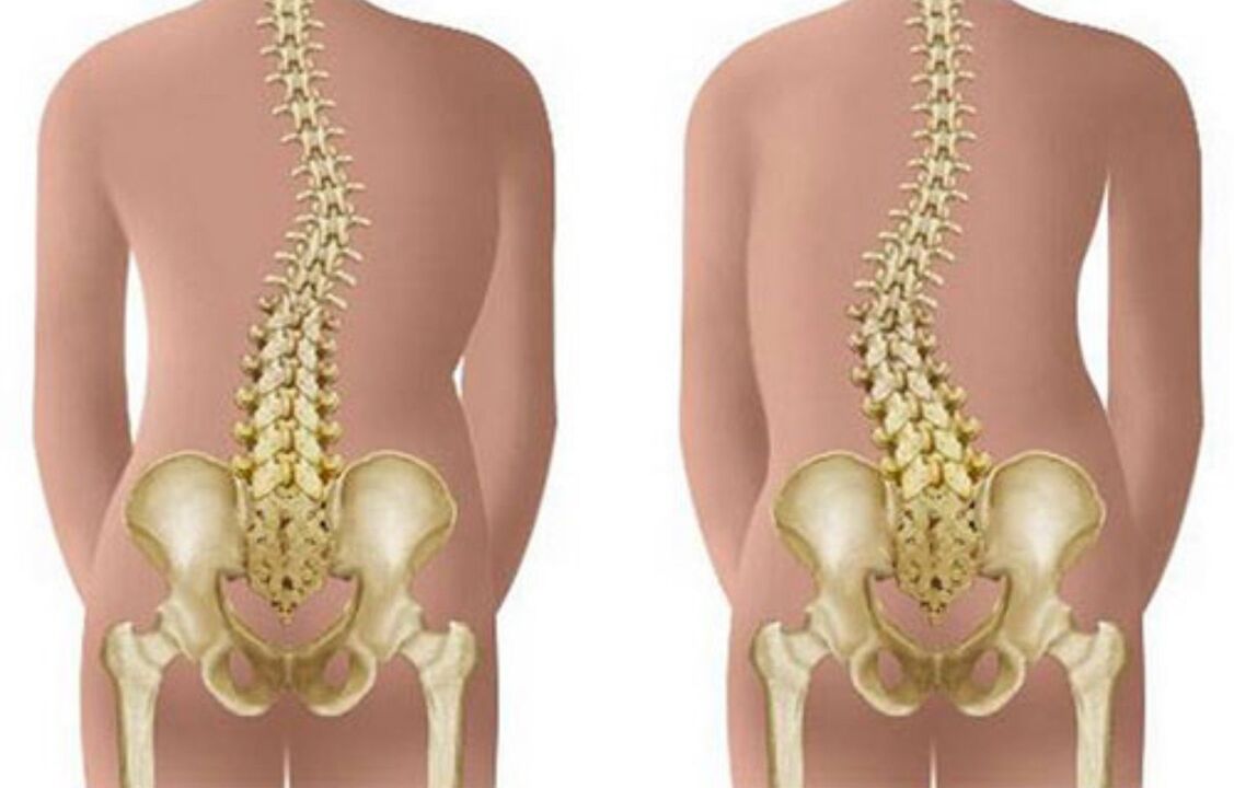 scoliosis as a cause of back pain in the shoulder blade area