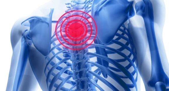 Treatment of thoracic spine osteochondrosis