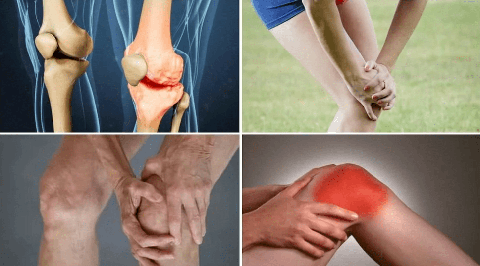 Arthrosis symptoms