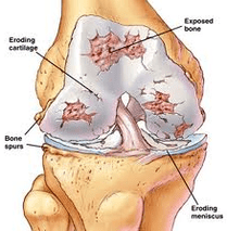 The Arthrosis Development Mechanism